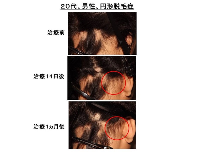 円形脱毛症　病院""